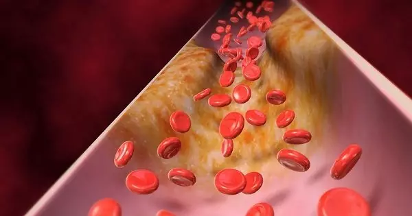 La acumulación de placas en las arterias hace que envejezcamos más rápido