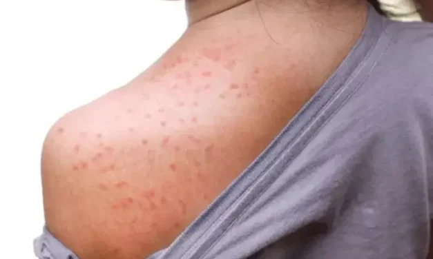 Virólogo: El sarampión mata y se transmite muy rápido, urge una campaña de concientización