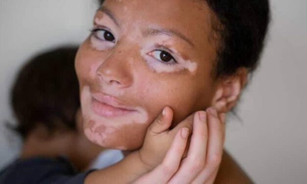 Día Mundial del Vitiligo: una condición que afecta a un 2 % de las personas a nivel mundial